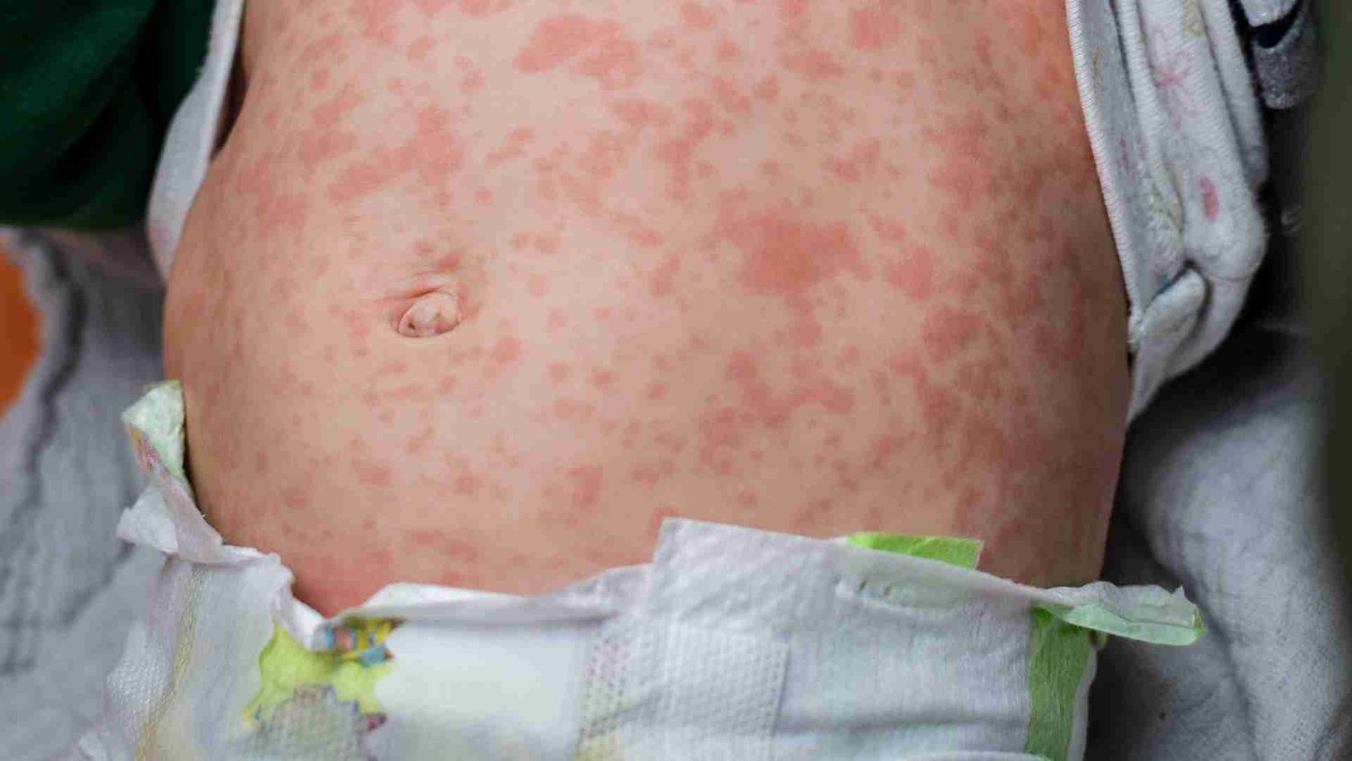 Atención pediátrica de alergias